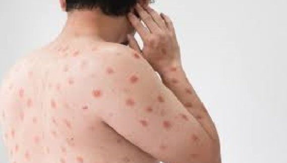 Mpox: Advisory issued for prevention and prevention of monkey pox disease in Chhattisgarh, instructions to be cautious regarding swine flu and diarrhea also